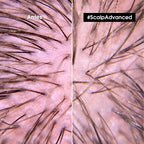 Shampoo anti-grasa Scalp Advanced