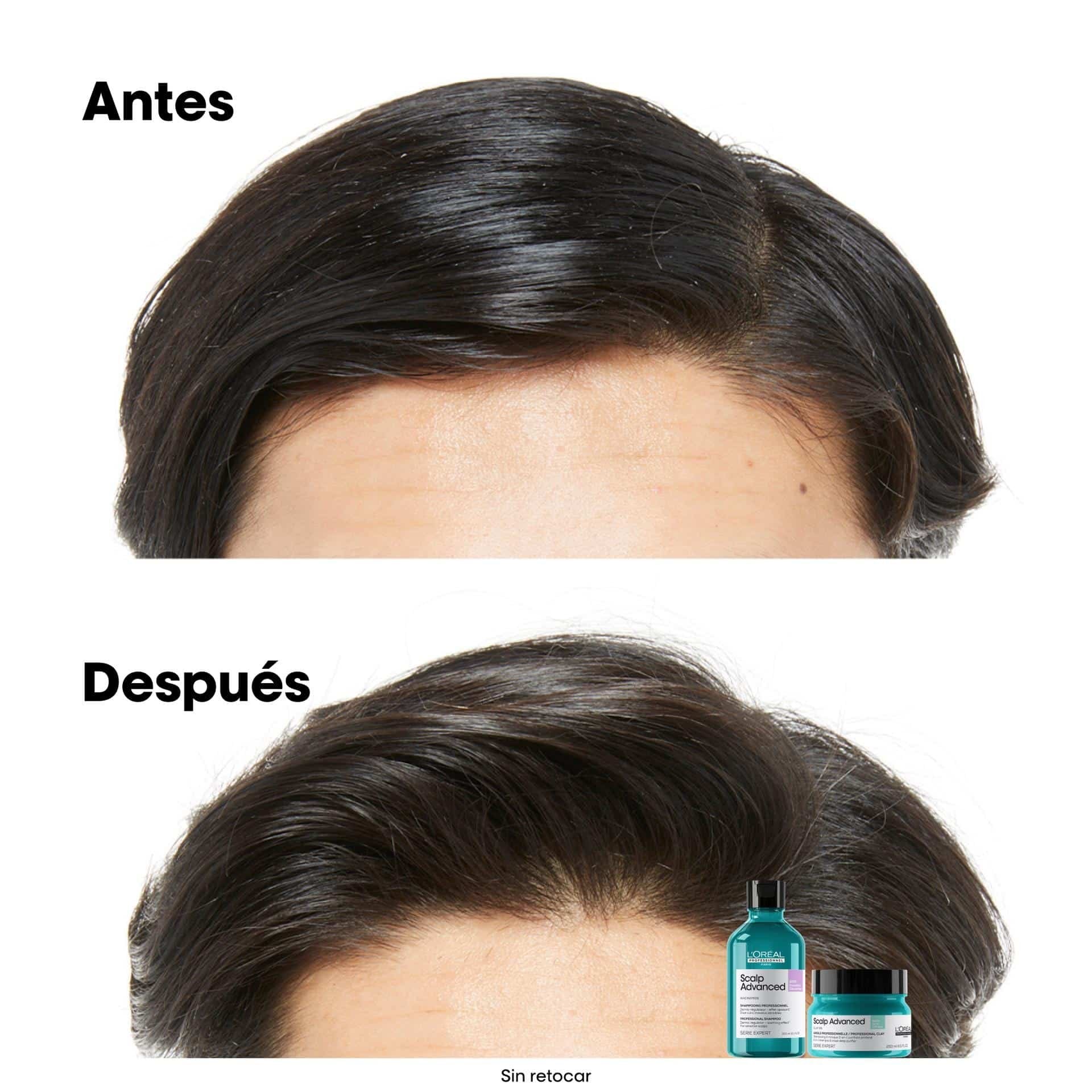 Shampoo anti-grasa Scalp Advanced